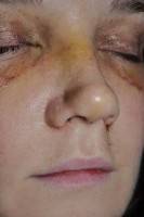 Plastic surgery nose recovery time image