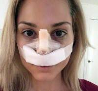 Plastic surgery nose recovery time photo