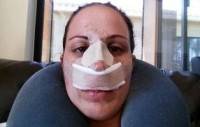 Recovery from nose job photos after surgery