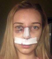 Recovery from rhinoplasty procedure pictures