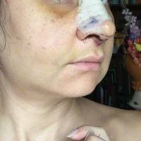 Recovery from rhinoplasty surgery photos
