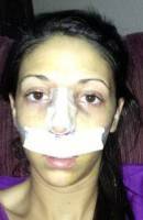Recovery picture after rhinoplasty and septoplasty