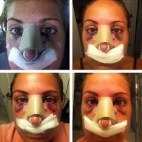 Recovery time for rhinoplasty surgery