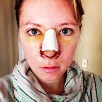 Remove bump on nose recovery after