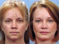 Rhinoplasty and chin augmentation surgery