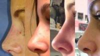 Rhinoplasty cost picture