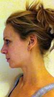 Rhinoplasty costs pictures