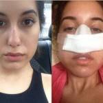 Rhinoplasty images Mexico top best plastic surgeons images