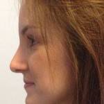 Rhinoplasty images Vancouver top best plastic surgeons pictures