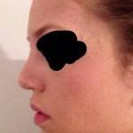 Rhinoplasty images operation picture