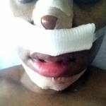 Rhinoplasty post op pictures Sacramento top best cosmetic surgeons pics