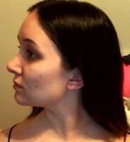 Rhinoplasty post op pictures dorsal hump remove