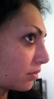 Rhinoplasty results nose job