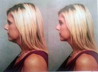 Rhinoplasty surgery photo picture cost