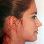 Rhinoplasty surgery pictures Chicago best cosmetic surgeons pictures