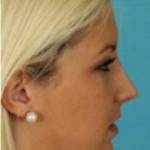 Rhinoplasty surgery pictures Jacksonville top best cosmetic surgeons shapshots