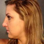 Rhinoplasty surgery pictures New York top best cosmetic surgeons shapshots