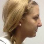 Rhinoplasty surgery pictures Texas top best surgeons pics