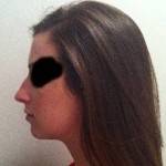 Rhinoplasty surgery pictures UK top plastic surgeons pictures
