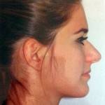 Rhinoplasty surgery pictures nyc top best plastic surgeons