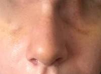 Swelling operation after rhinoplasty