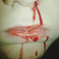 The bleeding after rhinoplasty picture