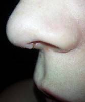 The scar after open rhinoplasty