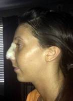 Tip rhinoplasty procedure nose job
