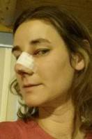 Upturned nose after rhinoplasty recovery