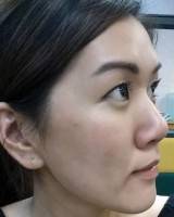 Upturned nose rhinoplasty surgery asian