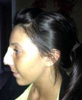What is Tip Rhinoplasty surgery