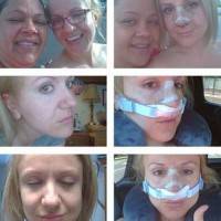 cosmetic nose surgery photos