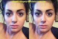 cosmetic rhinoplasty surgery before and after