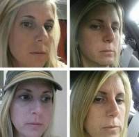 About rhinoplasty before and after