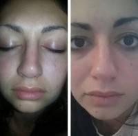 Asymmetrical nose after rhinoplasty surgery