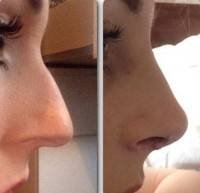 Before and after middle eastern rhinoplasty