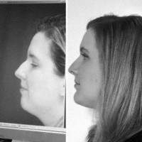 Complicated rhinoplasty before and after