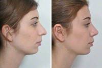 Computer morphing rhinoplasty before and after