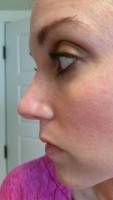 Crooked nose rhinoplasty before after operation