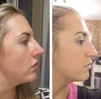 Deprojection rhinoplasty before and after
