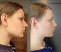 Dorsal hump reduction procedure photos