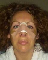Facelift and nose job