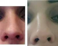 Fillers after rhinoplasty before and after