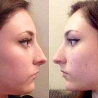 Is closed or open rhinoplasty surgery better