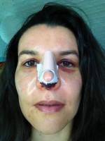 Lump in nose cartilage after nose job