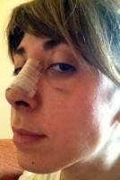 Nose Tip After Rhinoplasty too high