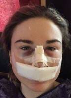 Nose cast after rhinoplasty pictures