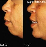 Nose job and chin implant before and after