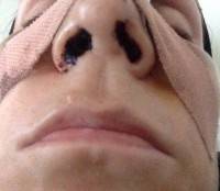 Nostril Reduction recovery after rhinoplasty