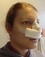 Recovery after rhinoplasty straighten nose